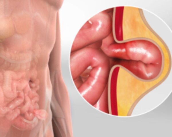 Laparoscopic Hernia Repair What Patients Should Know About Minimally Invasive Hernia Surgery
