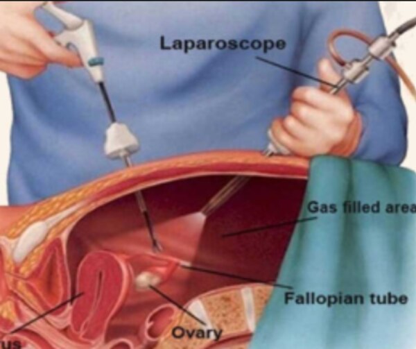 Laparoscopic Hysterectomy When Is Minimally Invasive Uterus Removal Surgery Recommended?