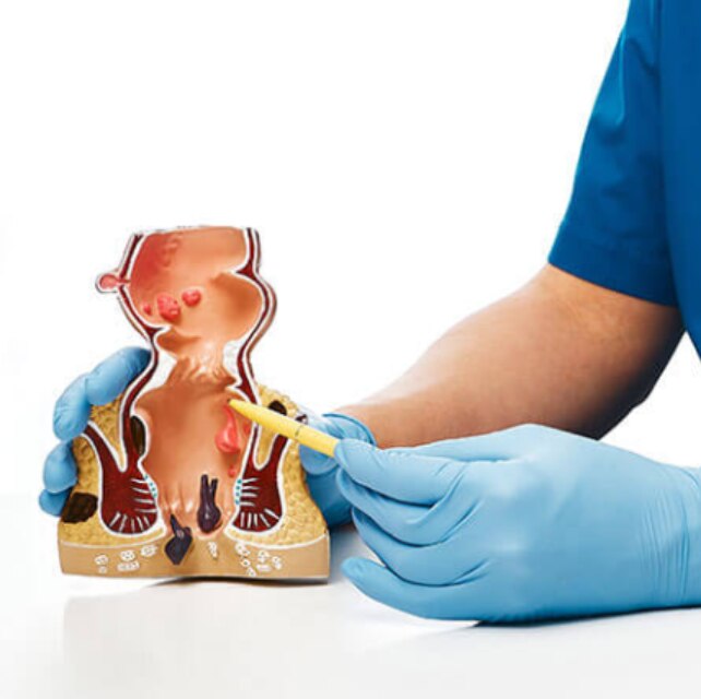 Fistula Treatment Why Anal Fistulas Develop and How They Are Treated