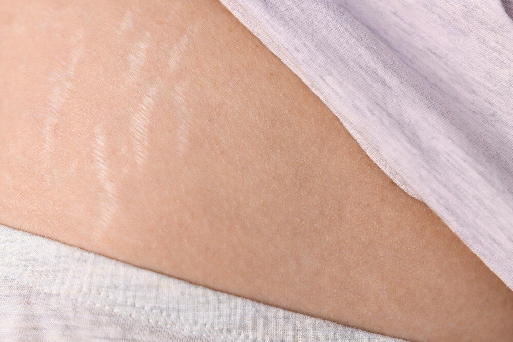 Stretch Mark Treatment Options After Pregnancy in Mumbai