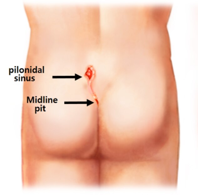 Pilonidal Sinus Common Causes, Warning Signs and When Surgical Treatment May Be Needed