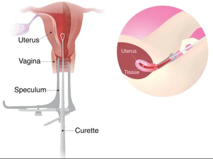 D and C Procedure in Mumbai with an Obstetrician Gynecologist