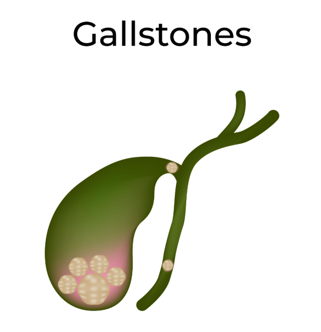 Gallbladder Stone Treatment Specialist in PCMC When Gallstones Need Active Treatment