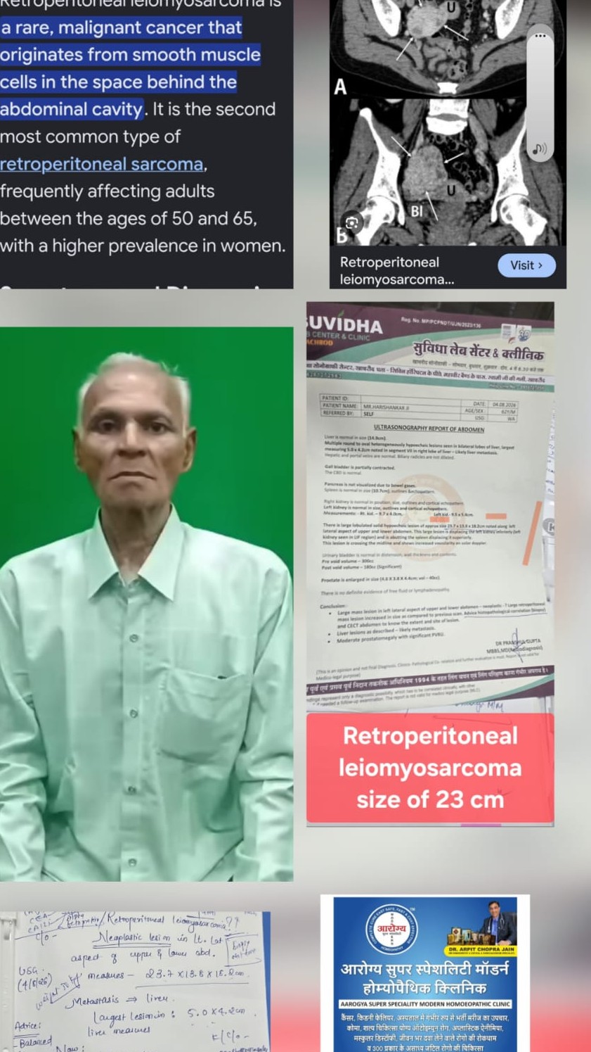 23.7x13.8x18.2 cm Retroperitoneal leiomyosarcoma large lesion , Critical.patient responded -Dr Arpit...