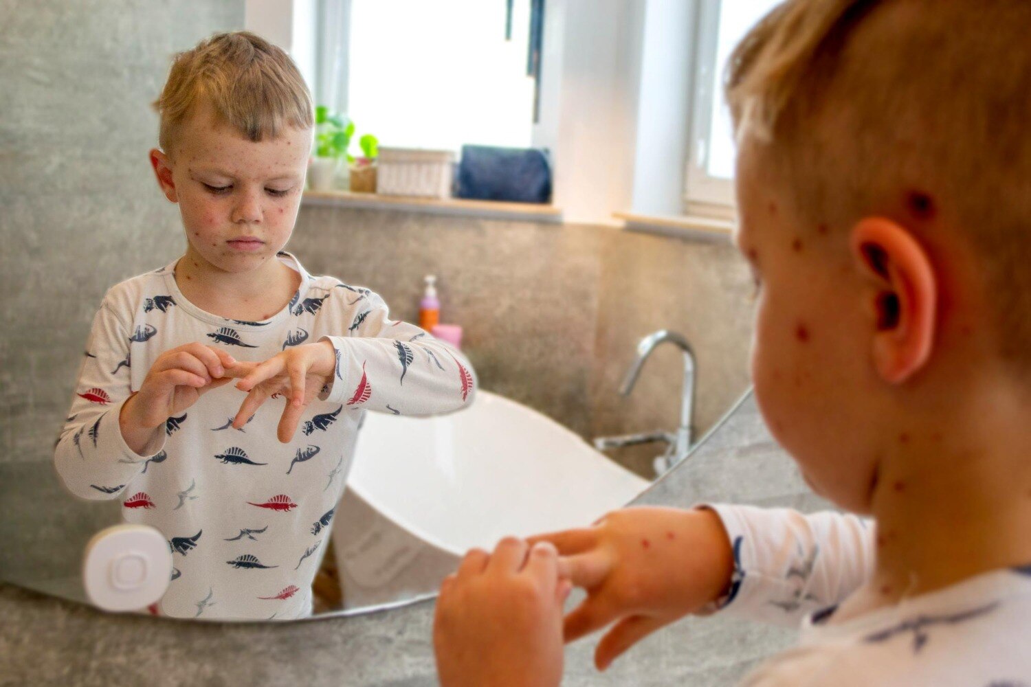 Treatment for Bacterial Skin Infections in Children Pune