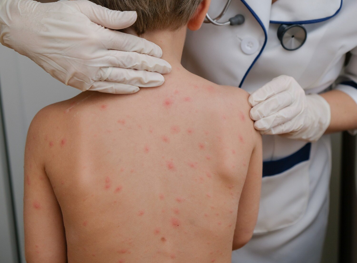 Child Skin Infection in Pimpri Chinchwad When to Seek Medical Care