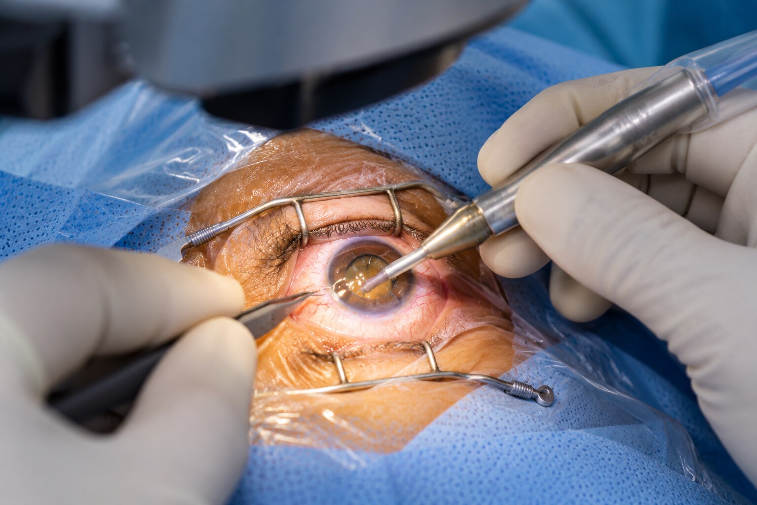 How Phacoemulsification Surgery Helps Remove Cataracts Through a Small Incision