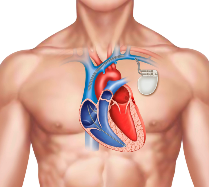 Pacemaker Implantation for a Slow Heartbeat What Patients Should Know