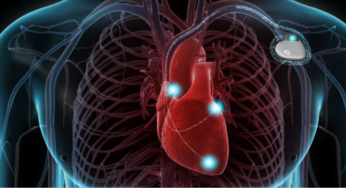 Choosing Care for ICD Implantation in Pune