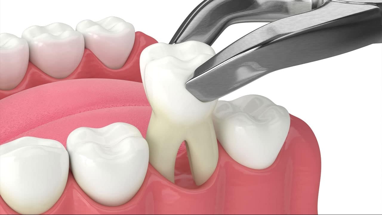 Best Extraction In Vashi