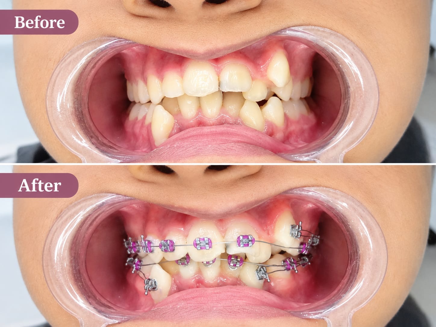 Braces Treatment In Vashi