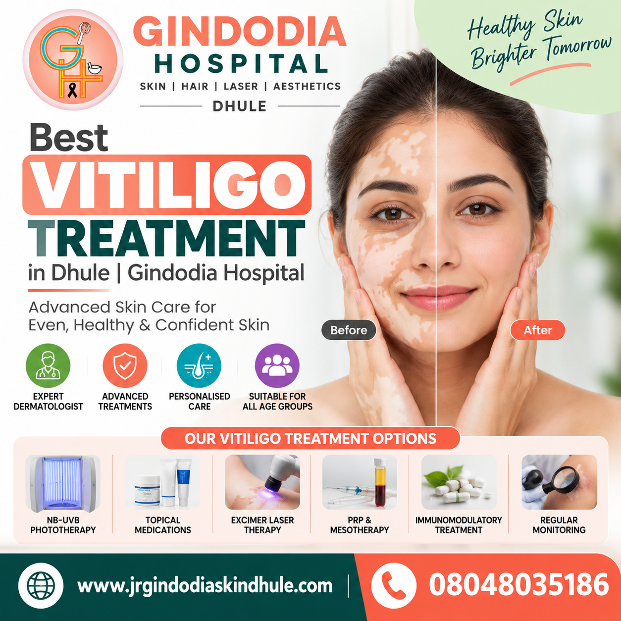 Best Vitiligo Treatment in Dhule | Gindodia Hospital