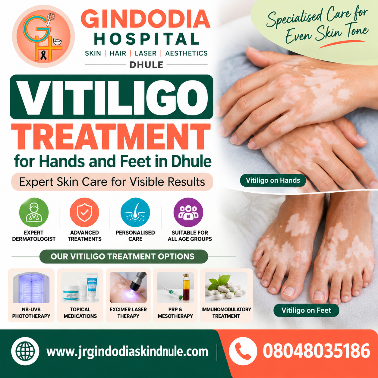 Vitiligo Treatment for Hands and Feet in Dhule | Gindodia Hospital