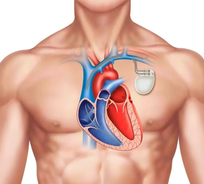 Permanent Pacemaker Readiness Checklist Before an Implant Procedure