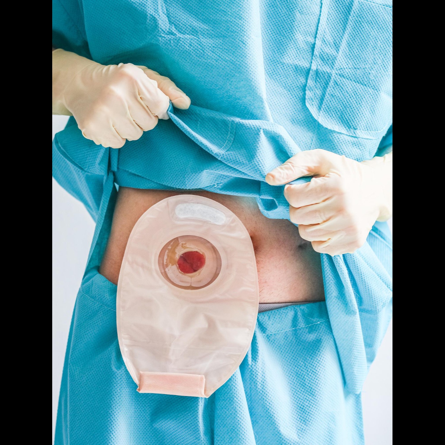 Laparoscopic Hiatus Hernia Repair with Fundoplication in Malad: Who May Need It?