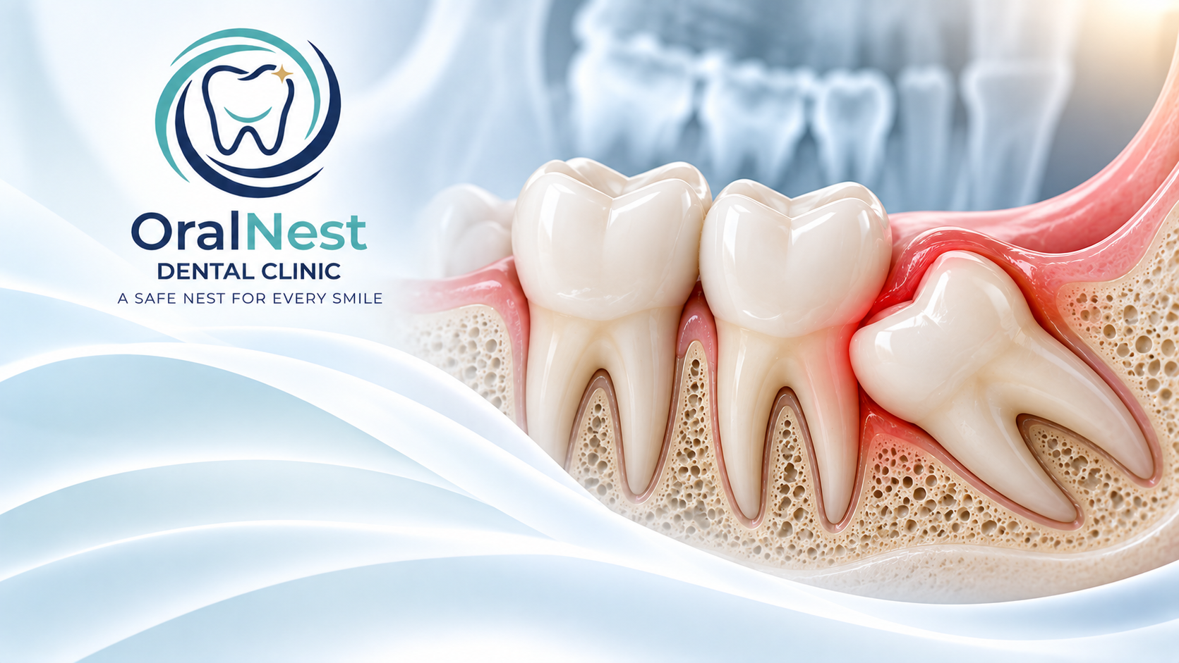 Wisdom Tooth Removal Near Kalewadi, Pune | OralNest Dental Clinic