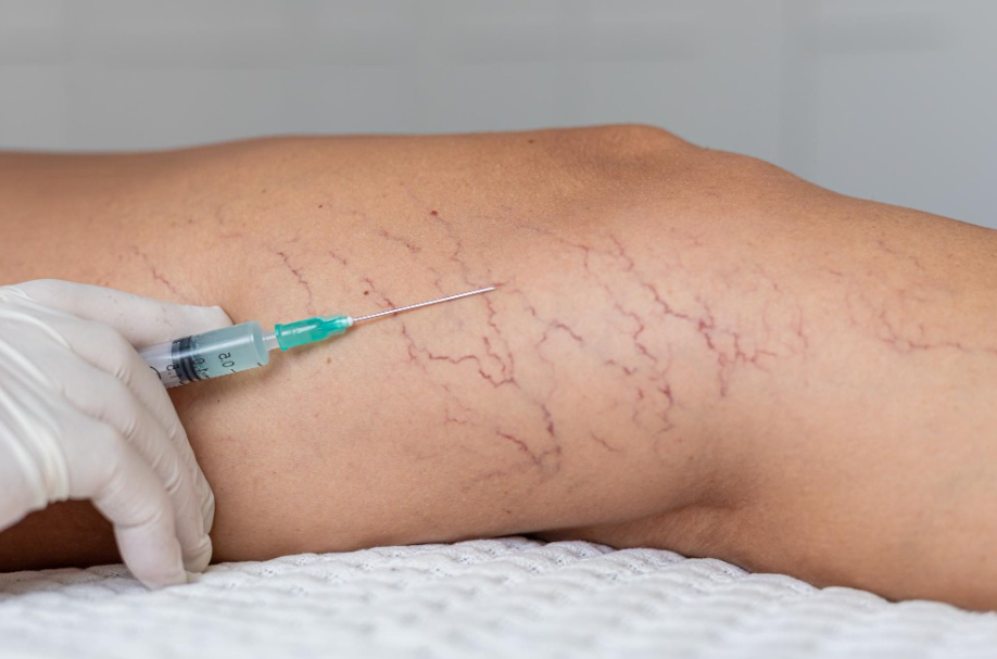 Vascular Surgery in Nagpur How to Choose Care for Blood Vessel Problems