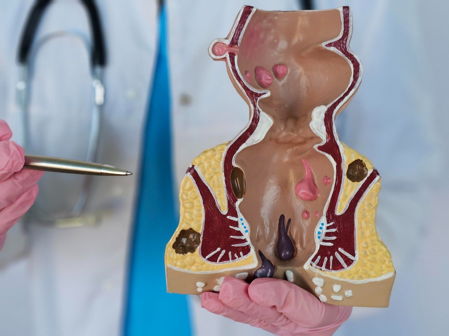 When Persistent Piles Symptoms May Need Treatment at a Piles Hospital