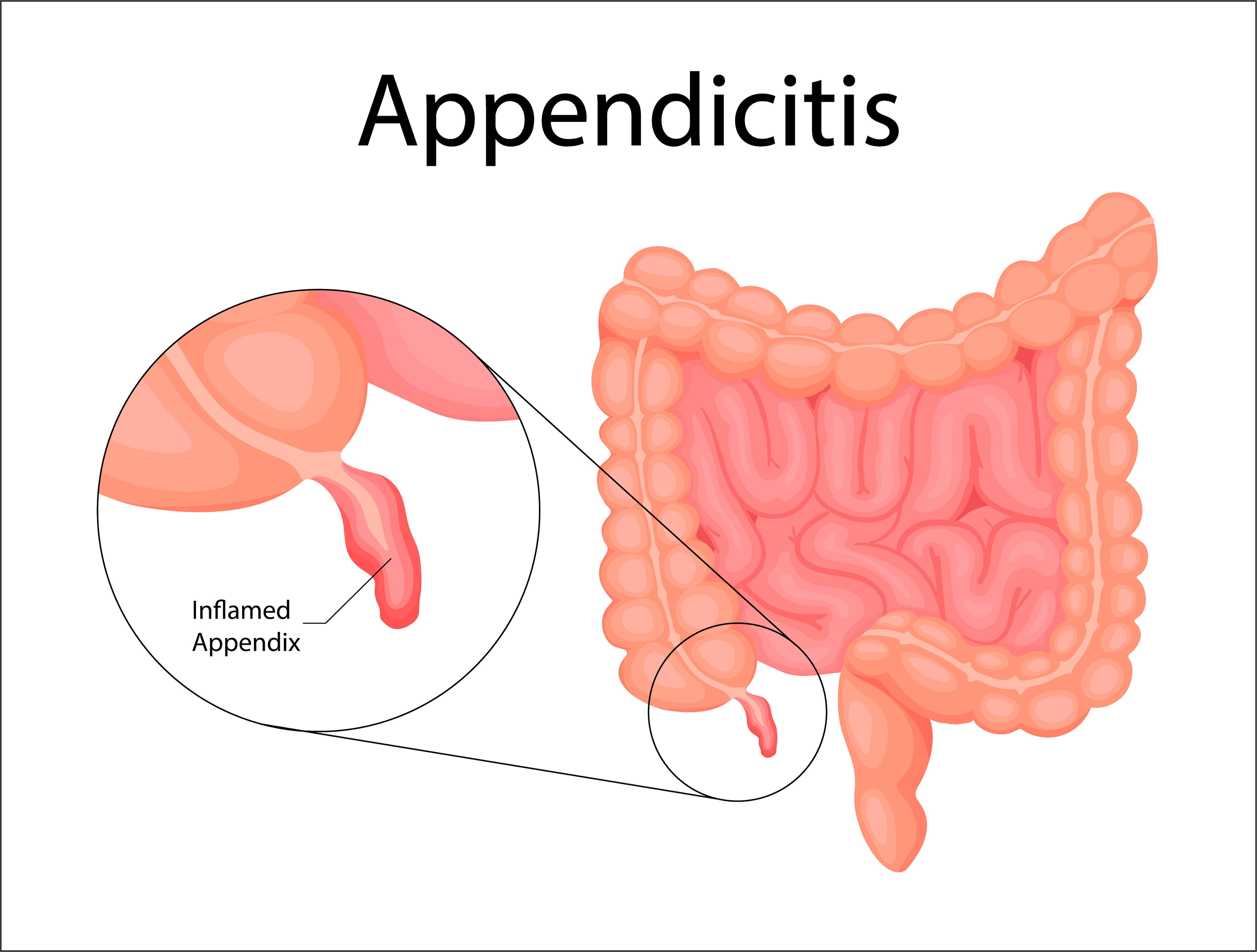 When Abdominal Pain Due to Appendicitis May Require Appendix Surgery