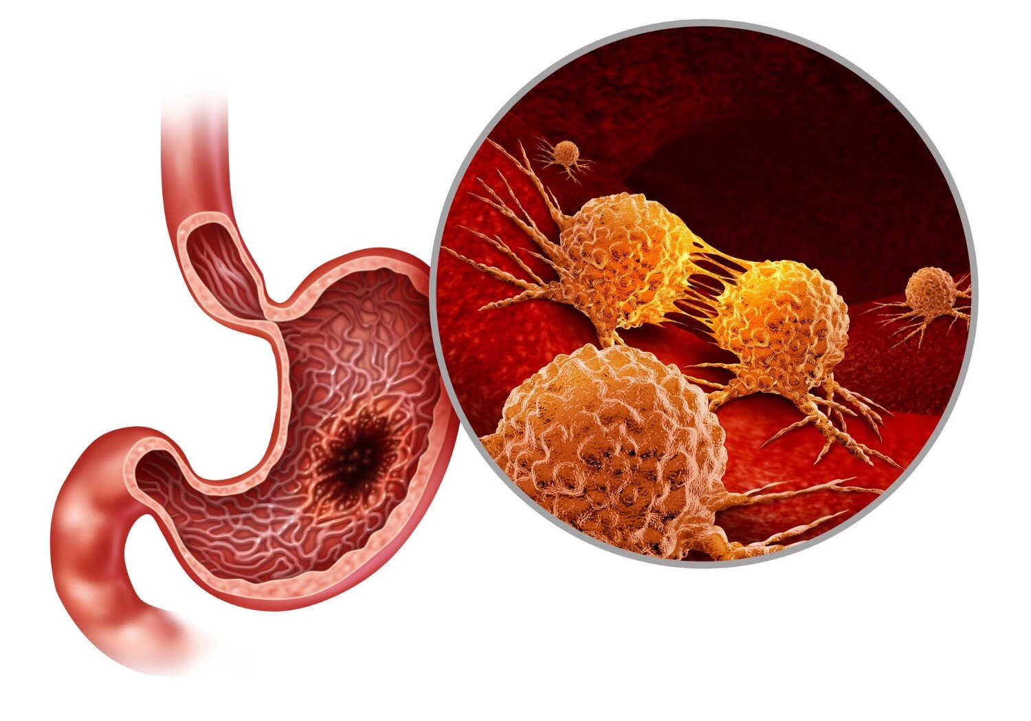 How Gastro Cancer Surgery Is Planned for Cancers of the Digestive System