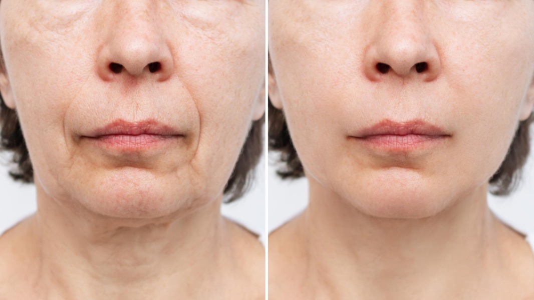 Anti-Aging Skin Treatment in Borivali With a Natural and Personalised Approach