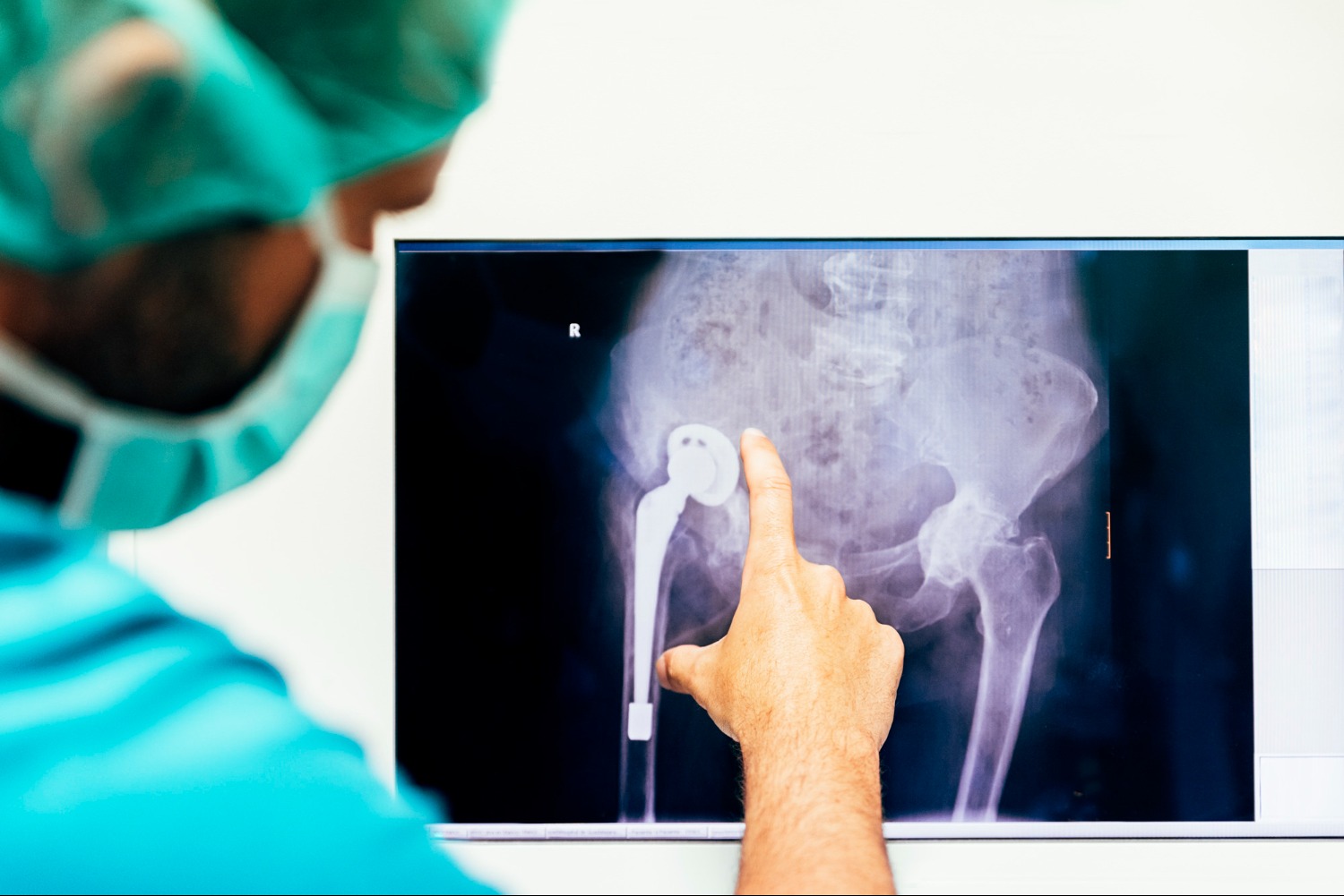 How to Evaluate the Best Hip Replacement Surgeon in Jaipur Before Surgery