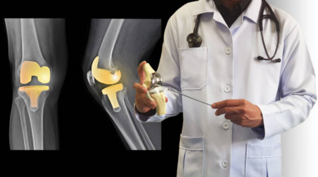 Subvastus Approach for TKR What Knee Replacement Patients in Bandra Should Ask Before Surgery