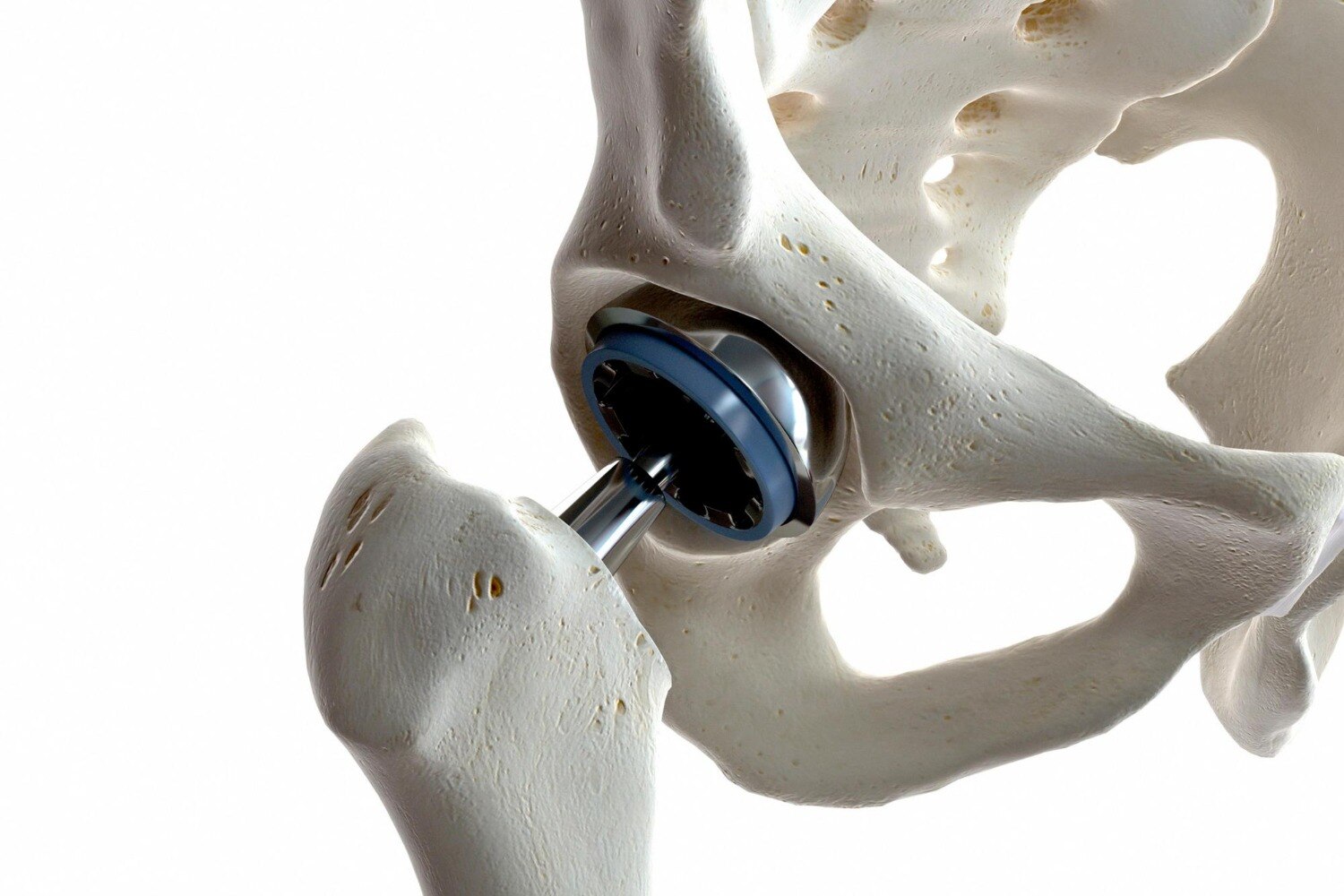Understanding Hip Replacement for Severe Joint Damage and Restricted Mobility