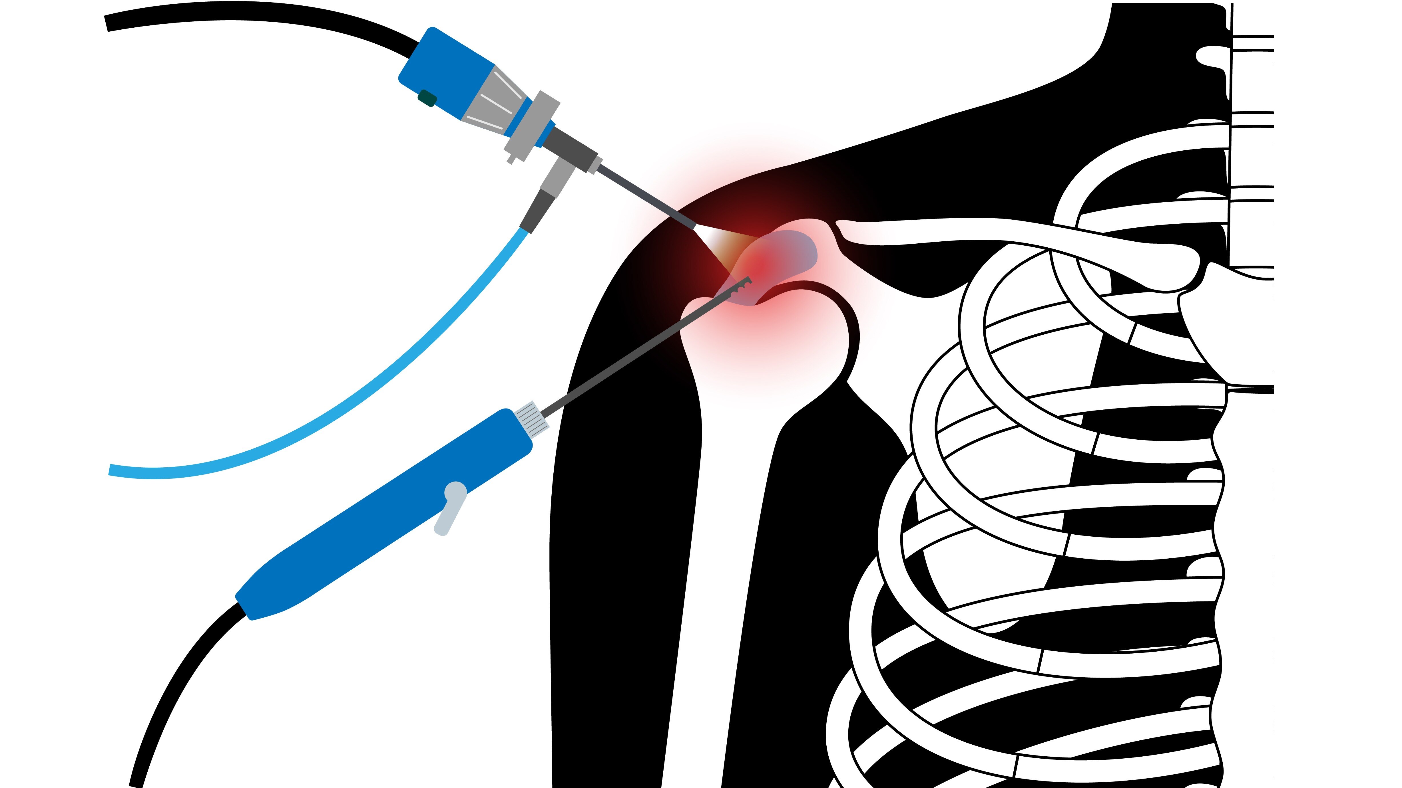 When Shoulder Arthroscopy May Be Recommended for Persistent Shoulder Problems