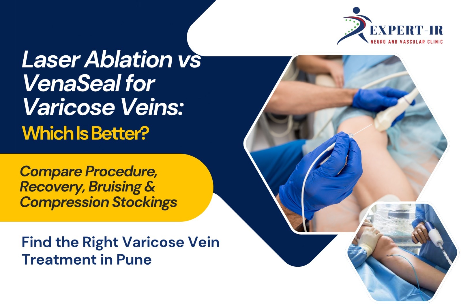 Laser Ablation vs VenaSeal for Varicose Veins: Which Is Better?