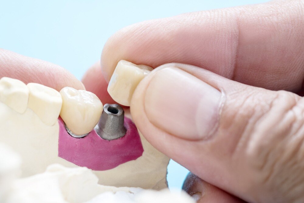 How a Single Tooth Implant Replaces a Missing Tooth Without Relying on Adjacent Teeth