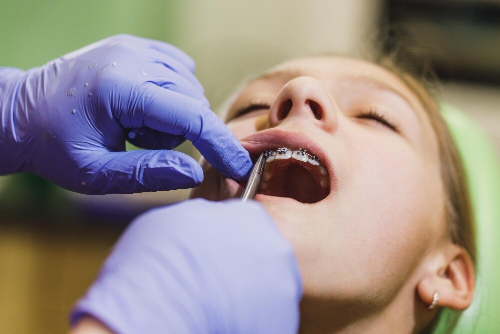 How Lingual Braces Treatment Straightens Teeth With Braces Placed Behind the Teeth