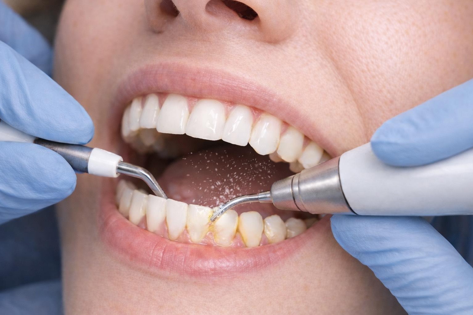 Does Dental Scaling Damage Teeth? | Dentist in Wakad, Pune