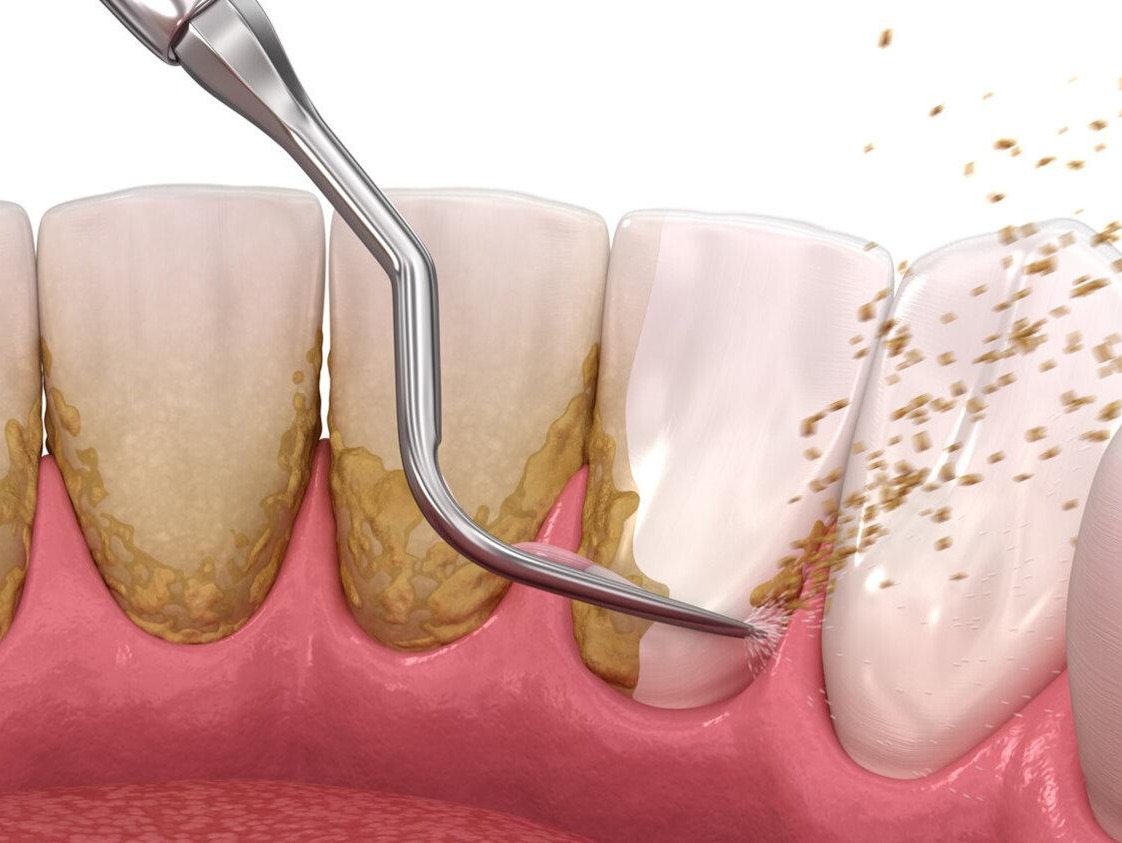 Bleeding Gums While Brushing | Dental Scaling in Wakad, Pune