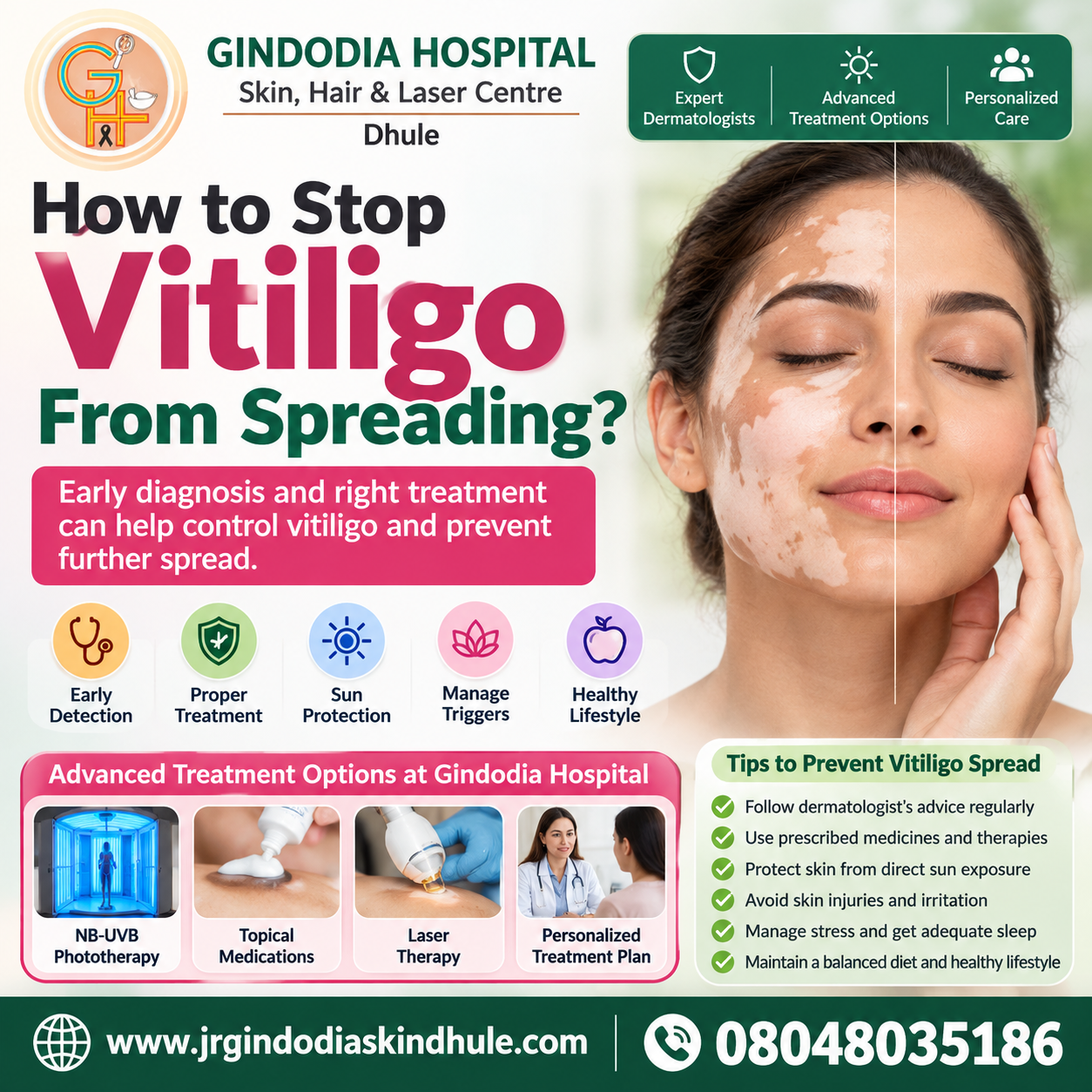How to Stop Vitiligo From Spreading | Gindodia Hospital