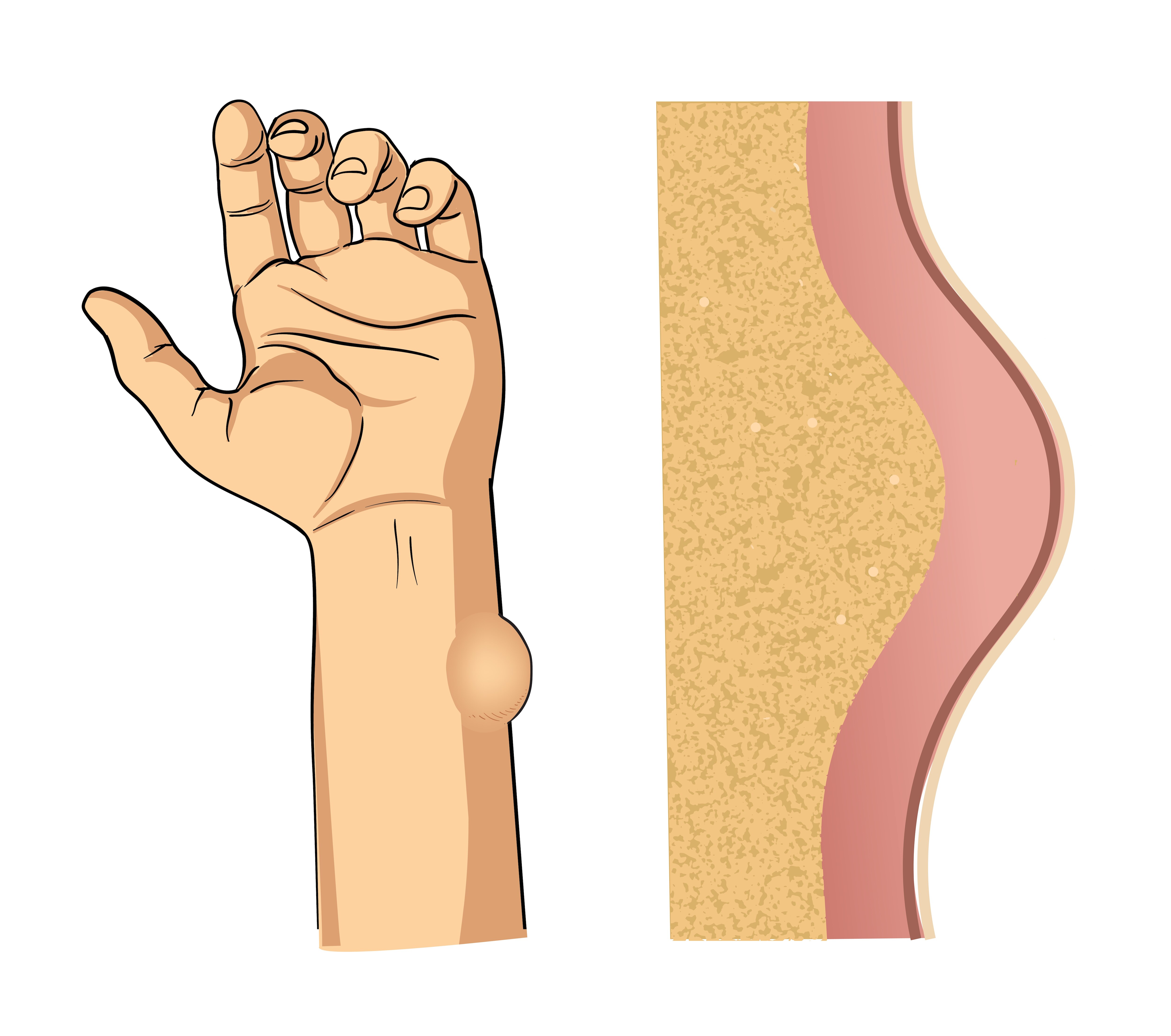 Soft Tissue Sarcoma Treatment Is Specialist Care Worth It