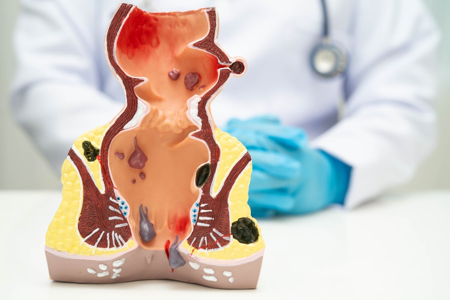 When Is Laser Piles Treatment Considered for Persistent Hemorrhoid Symptoms?