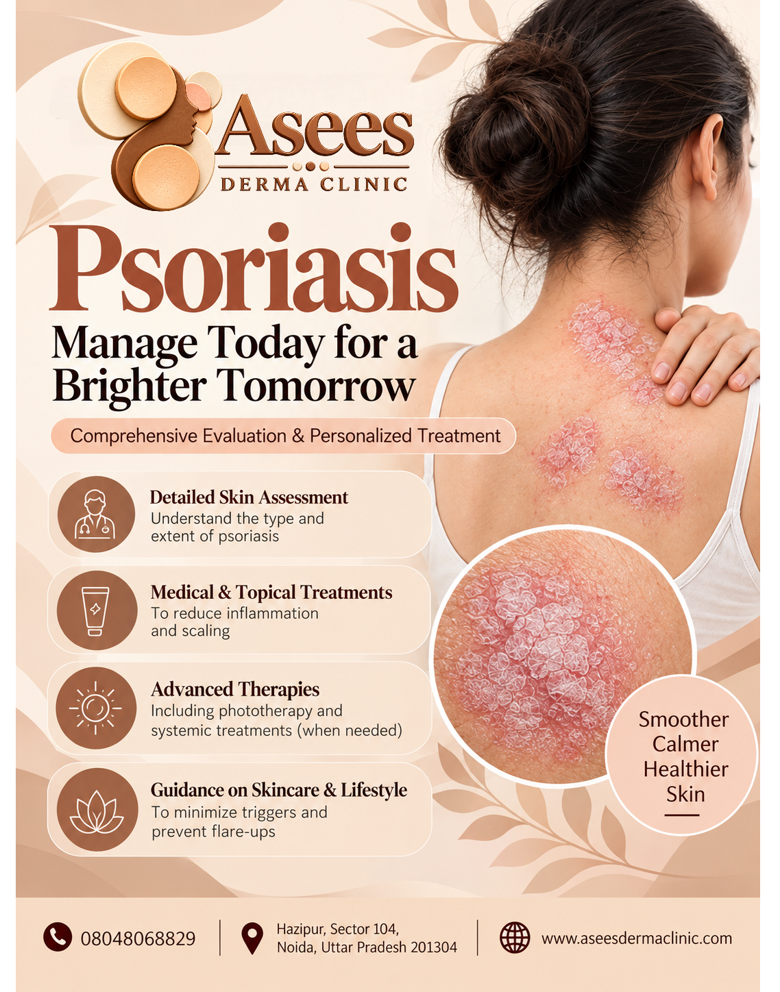 Psoriasis treatment