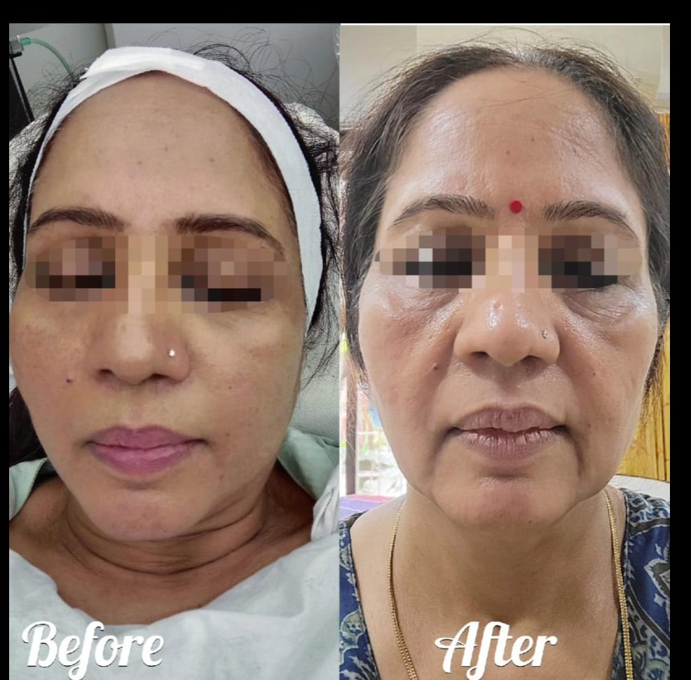 DR MESO PEN TREATMENT COMBINED WITH EXOSOMES IN VASHI