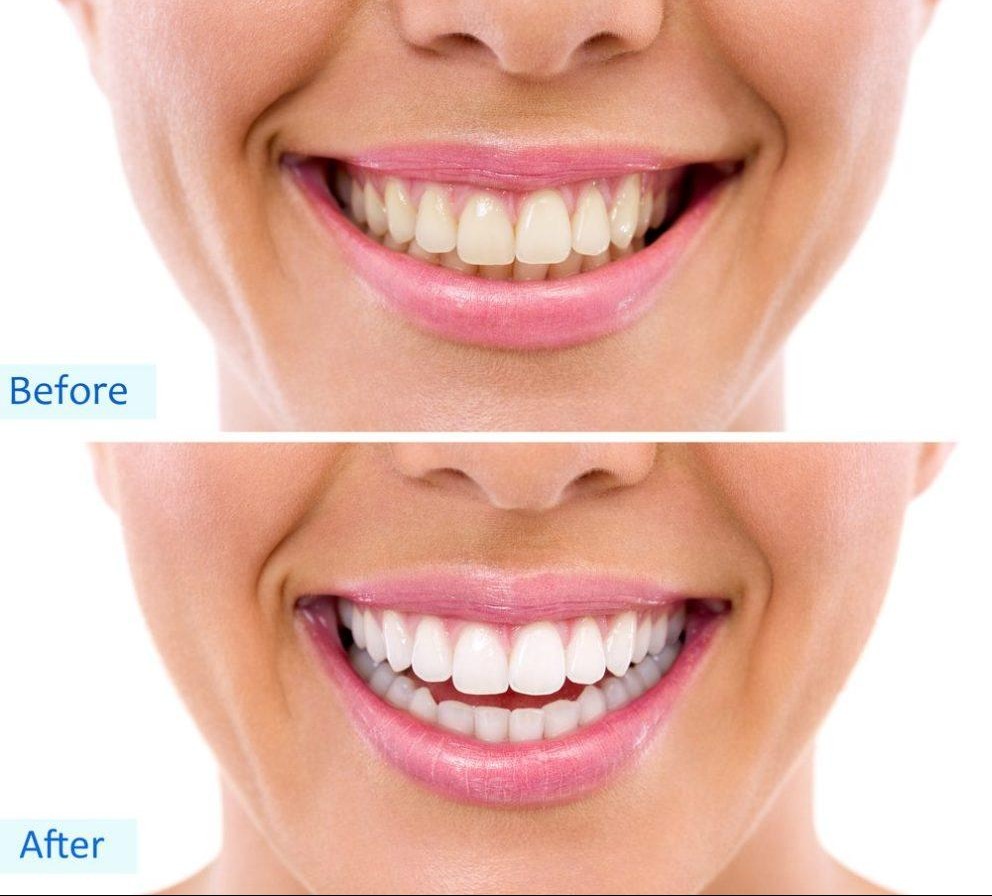 teeth whitening