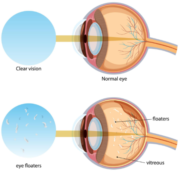 Retina Symptoms That Should Not Be Ignored Until Your Next Routine Eye Check