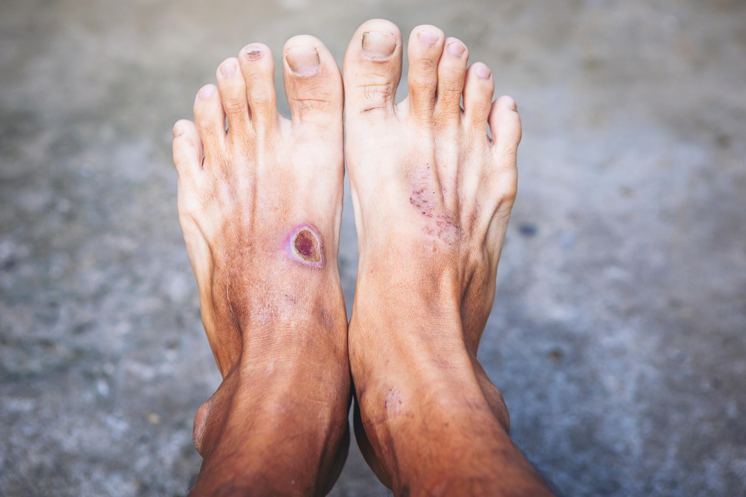 Diabetic Foot and Gangrene Specialist Mumbai: Know the Warning Signs