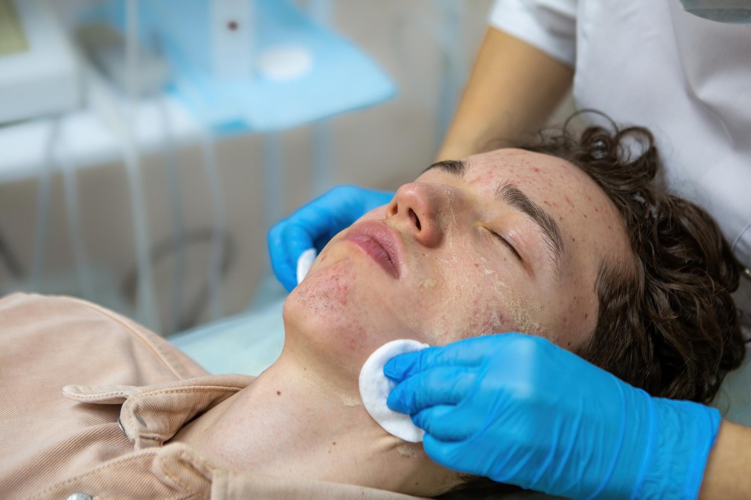 How Acne Scar Treatment Is Chosen for Different Types of Scarring