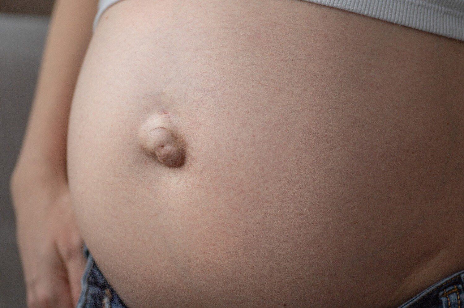 Umbilical Hernia or Urology Evaluation Which One Comes First