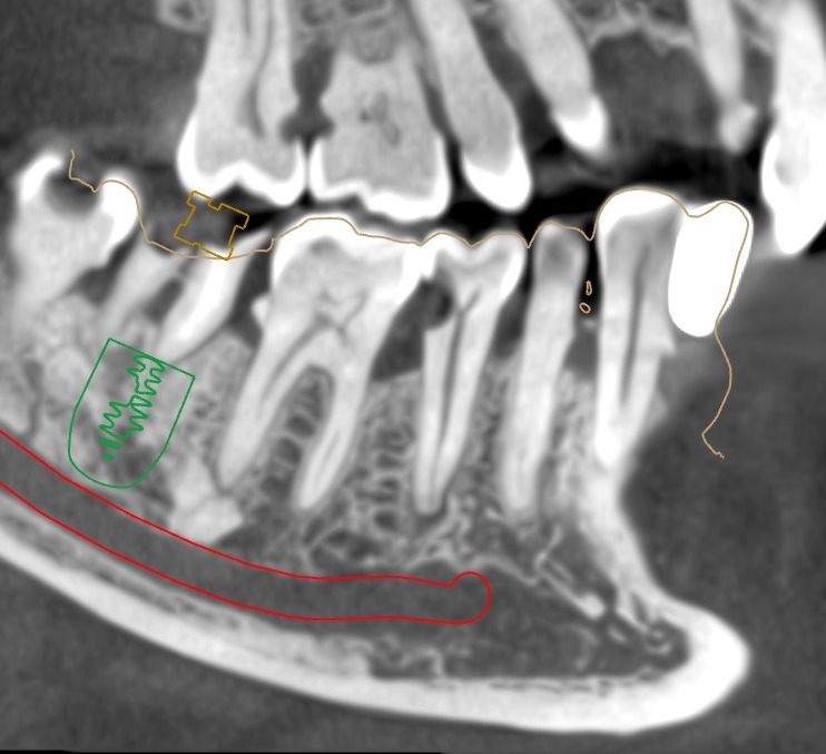 How to Compare Two Dental Treatment Plans Without Looking Only at Price