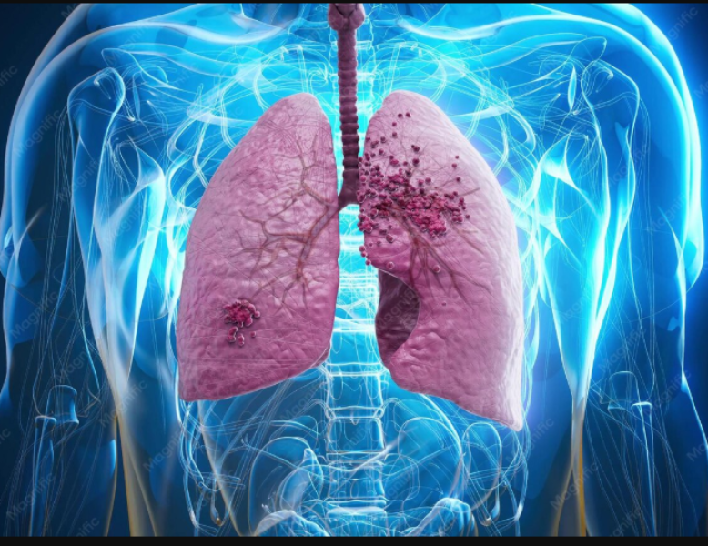 Lung Infection Treatment in Nagpur: Why the Cause Should Be Identified First