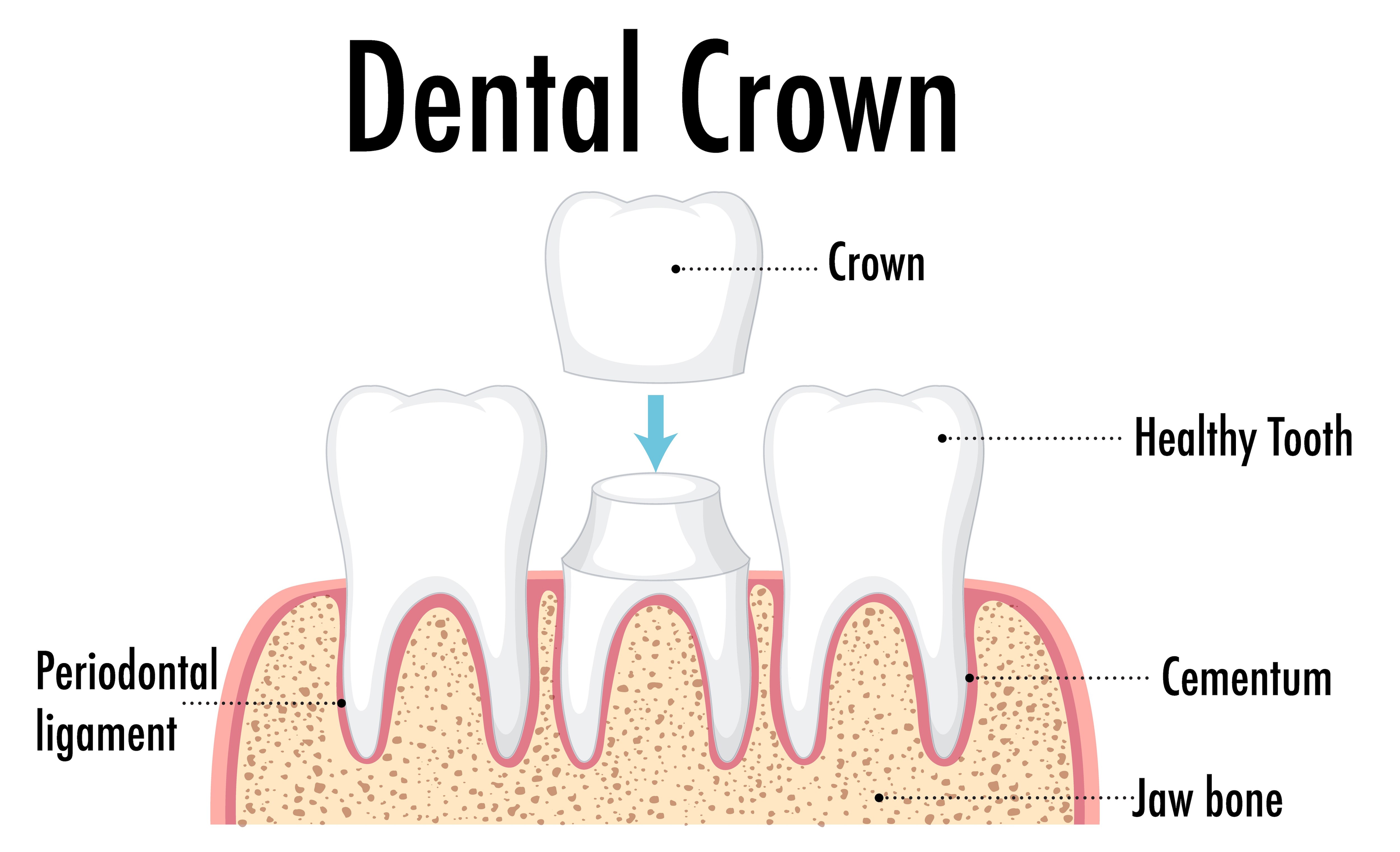 Where to Get Crowns and Bridges for Full Mouth Repair in Nashik