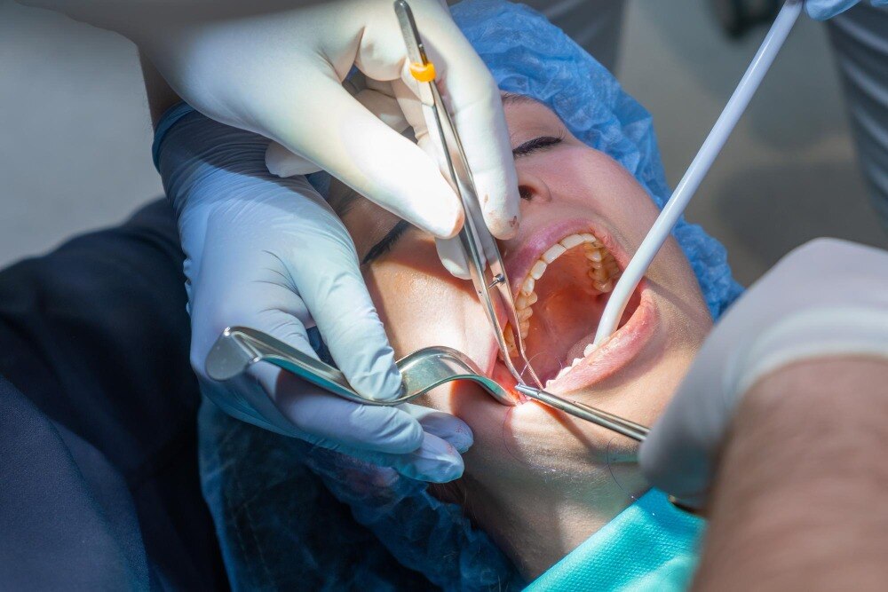 What to Eat After Oral Surgery for Wisdom Teeth
