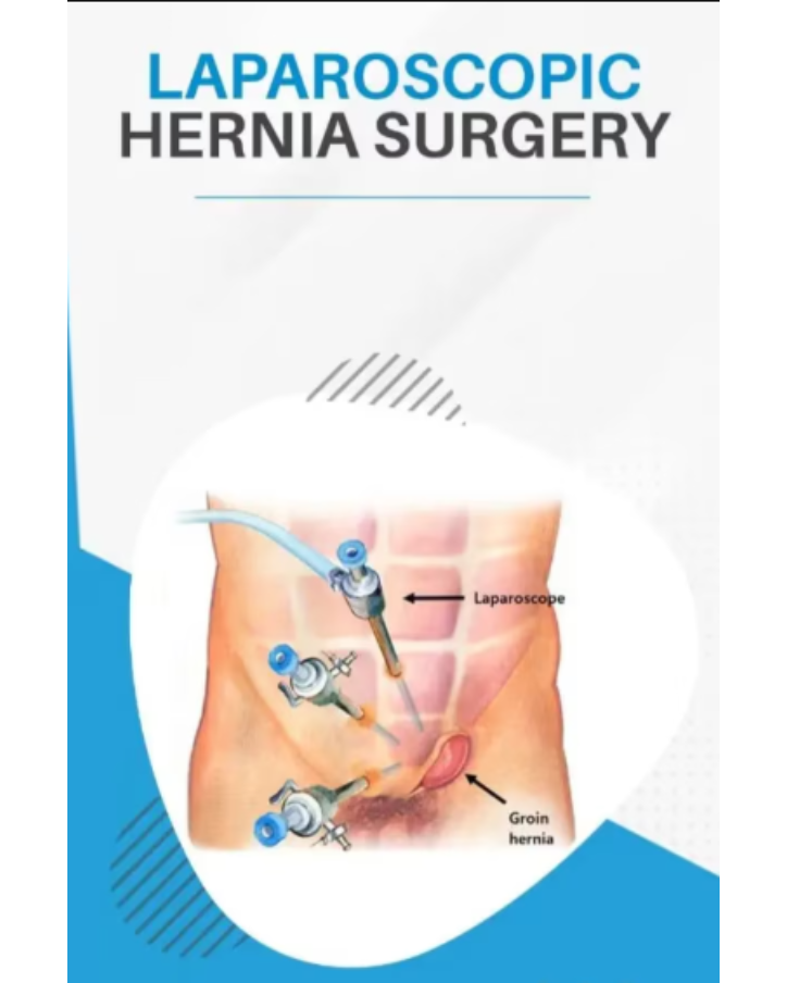 Laparoscopic Hernia Surgery in Ulhasnagar How to Know If You Are Ready for Repair