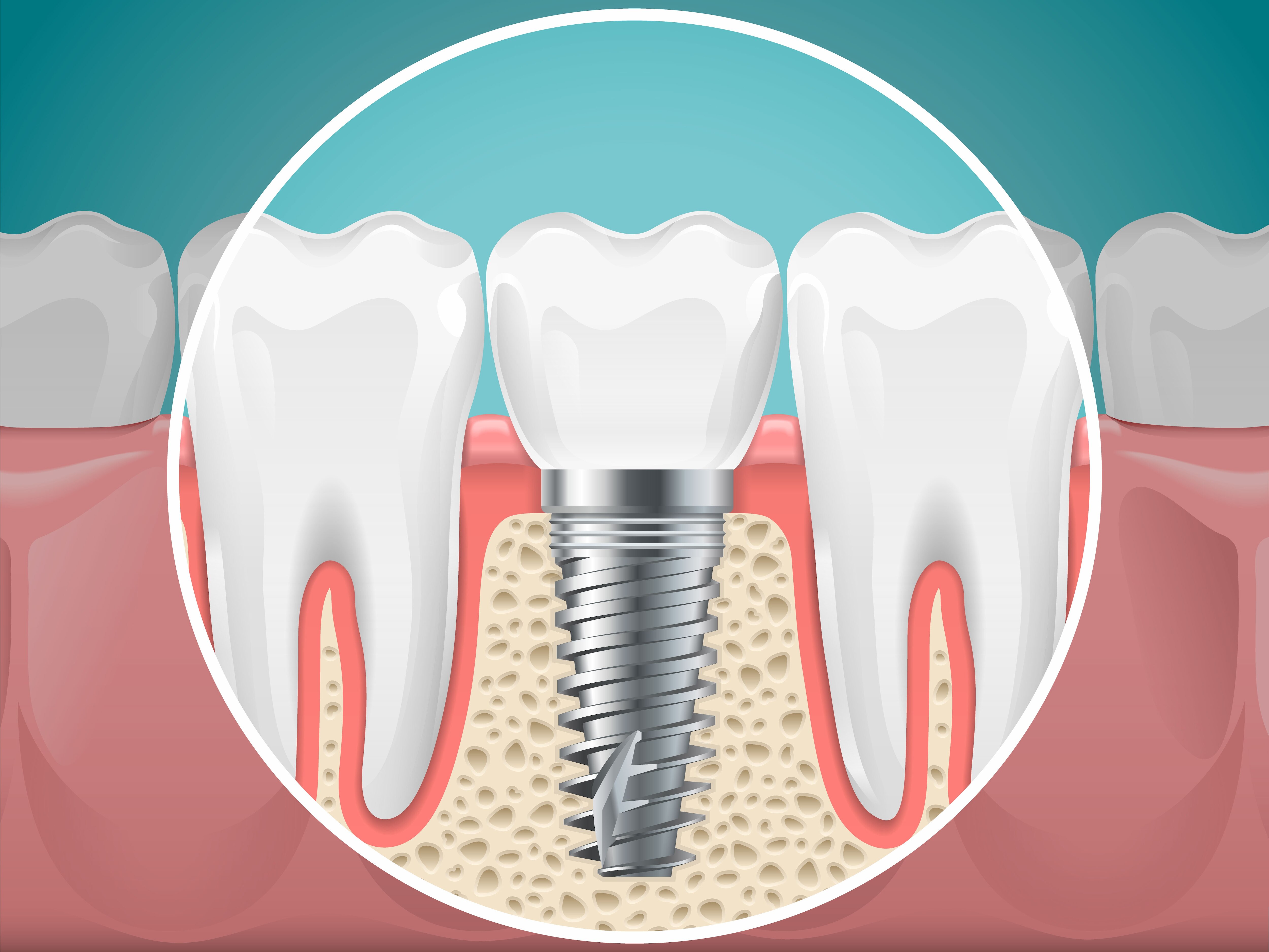Replacing Missing Teeth With Dental Implants for Better Function and Smile Appearance